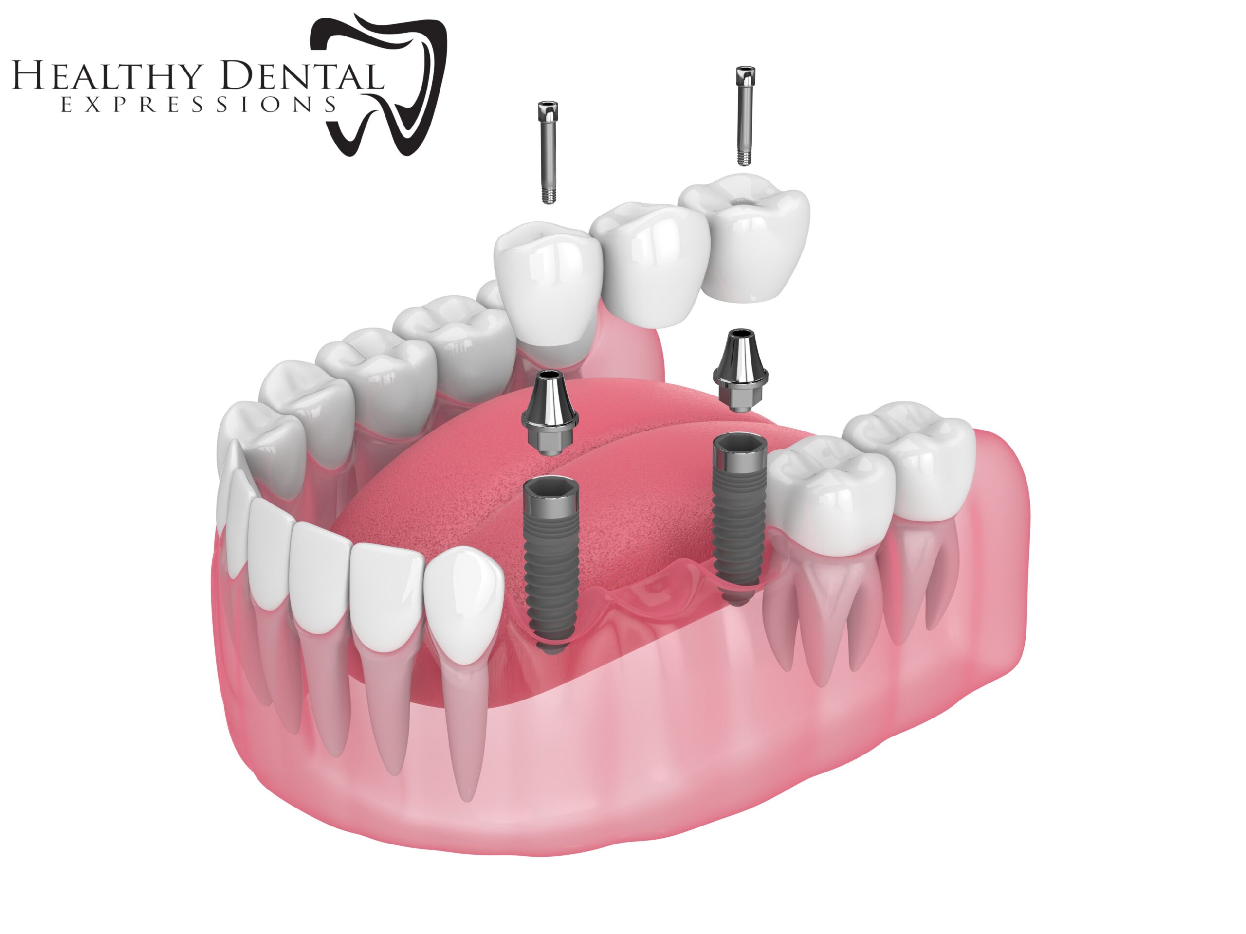 Dental implants, partial dentures, Healthy Dental Expressions, smile transformation, graphic designer's dental journey, custom crowns and bridges, patient satisfaction, family dental referrals, personalized dental care, Dr. Henry Suarez, Boynton Beach dentist, dental confidence, advanced dental solutions, aesthetic dental treatment, life-changing dentistry